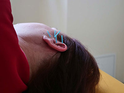 Physiotherapie Hänsch GmbH - Ihre Physiotherapiepraxis in Neuenhagen bei Berlin- Behandlungen Akupunktur